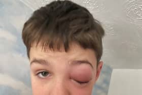 Zac Morey, nine, developed a severely swollen eye after contracting coronavirus