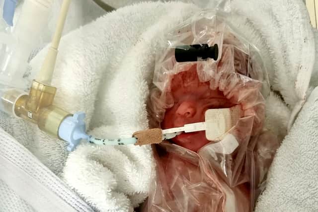 One of Britains tiniest babies born in Bristol weighing 1lb 4oz was so small he had to be wrapped in a plastic bag moments after being born 101 days early.