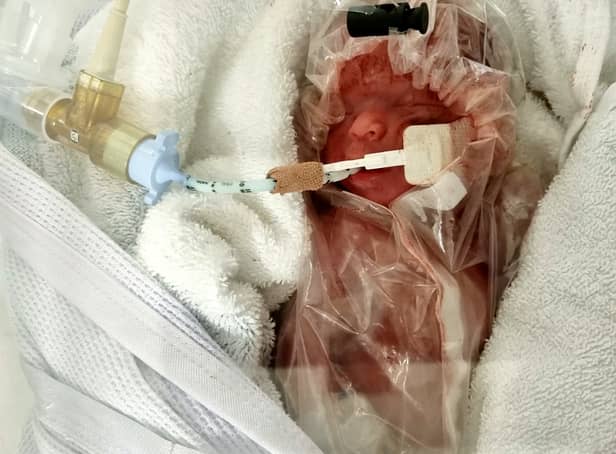 <p>Baby Pace miraculously survived despite mum Isabella Gailbraith giving birth to the tiny baby boy at just 25 weeks. </p>