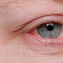 A new Covid variant, which has been found to be more infectious, is said to have an added rare symptom of conjunctivitis or pinkeye. 