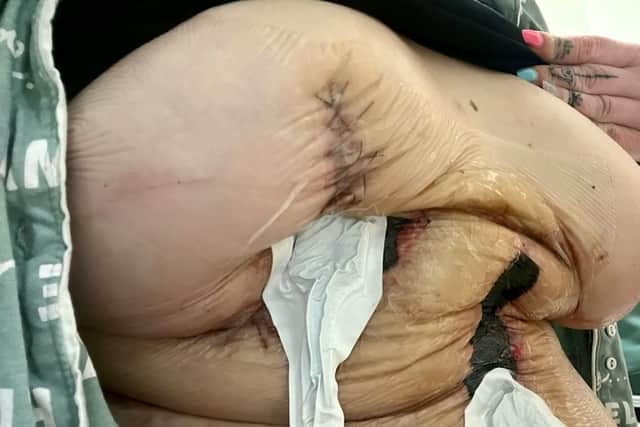 Botched Plastic Surgery Leaves Woman With 'Uniboob