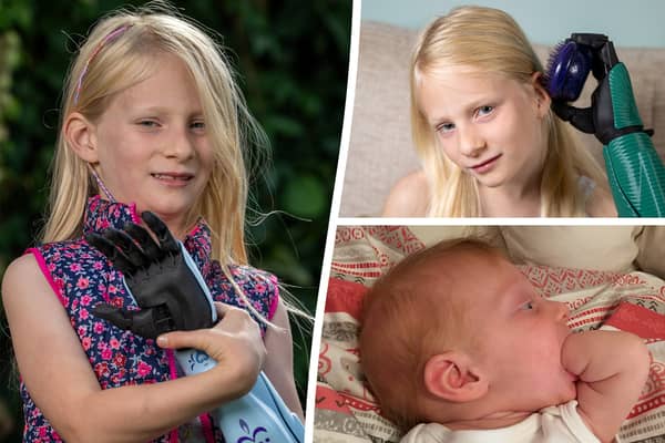 Caitlin Hutson was born with only one fully formed hand due to rare congenital condition