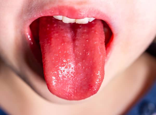 Tongue of a child with scarlet fever - strawberry tongue.
picture: Adobe.